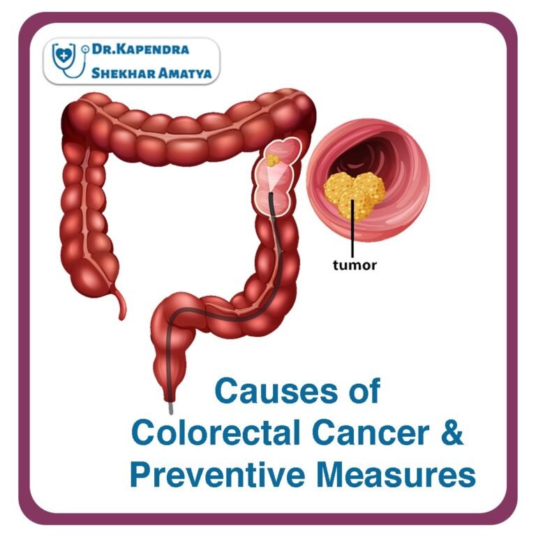 Causes of Colorectal Cancer and Preventive Measures