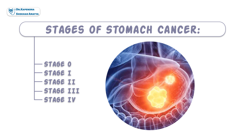 Stages of Stomach Cancer: