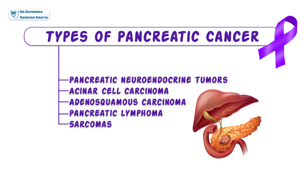 Types od pancreatic cancer