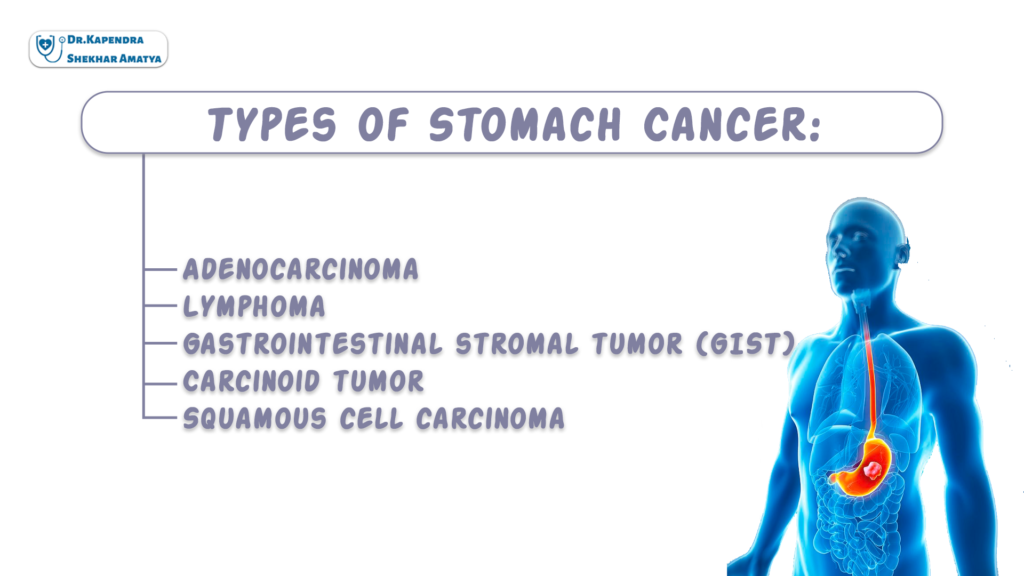 Types of Stomach Cancer: