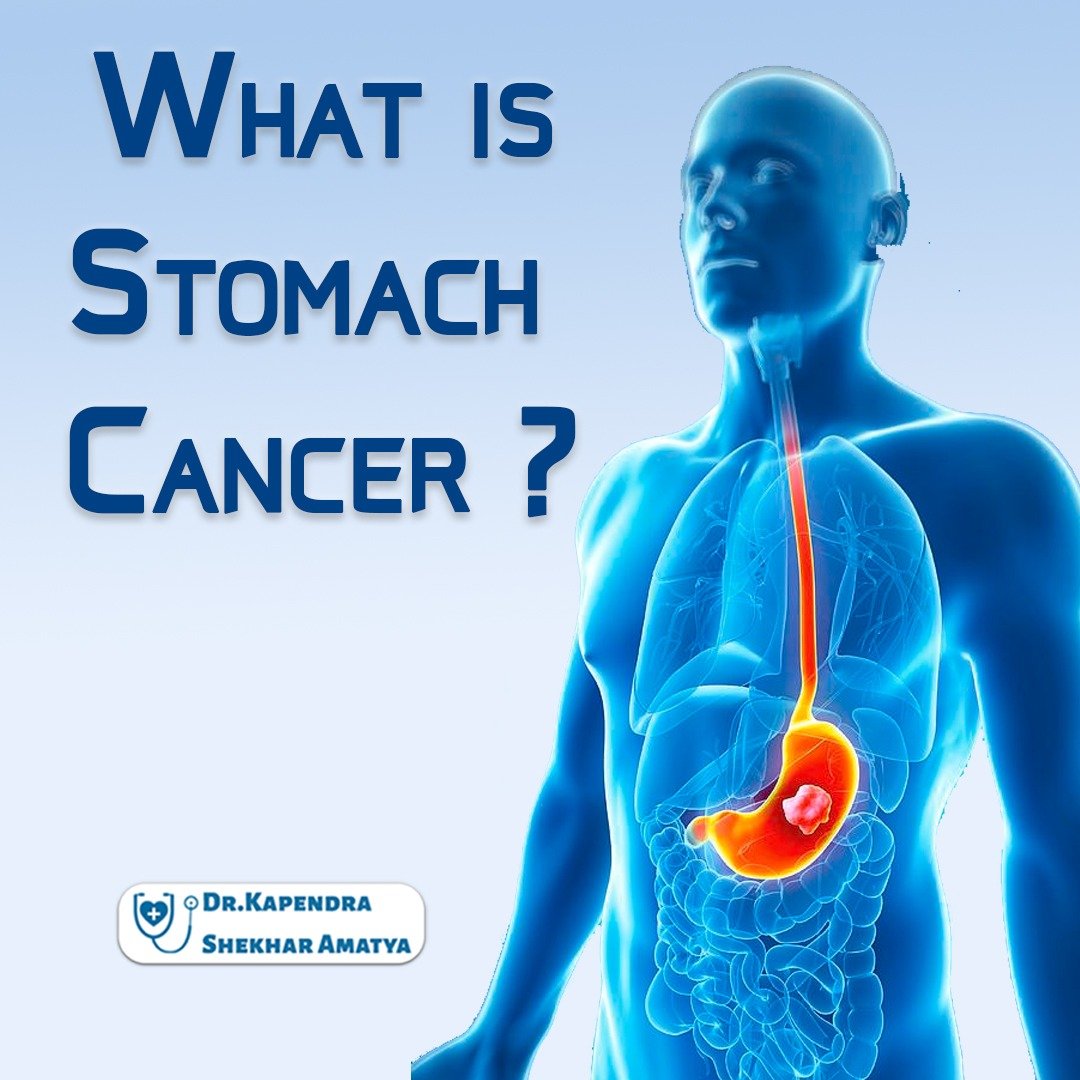 What is stomach cancer