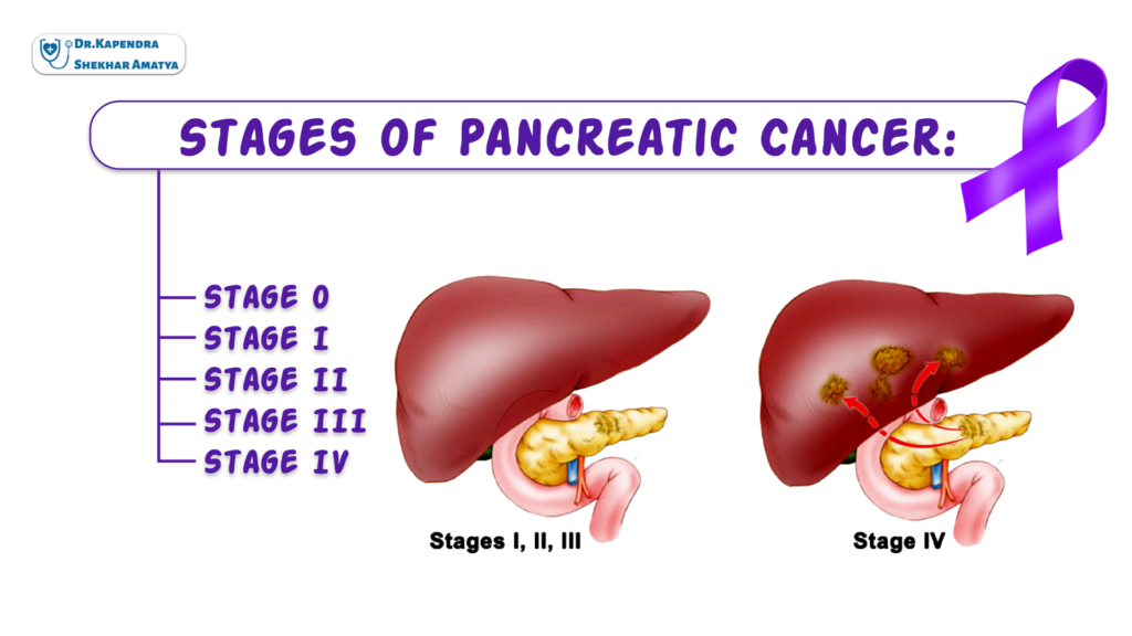 Stages of Pancreatic Cancer