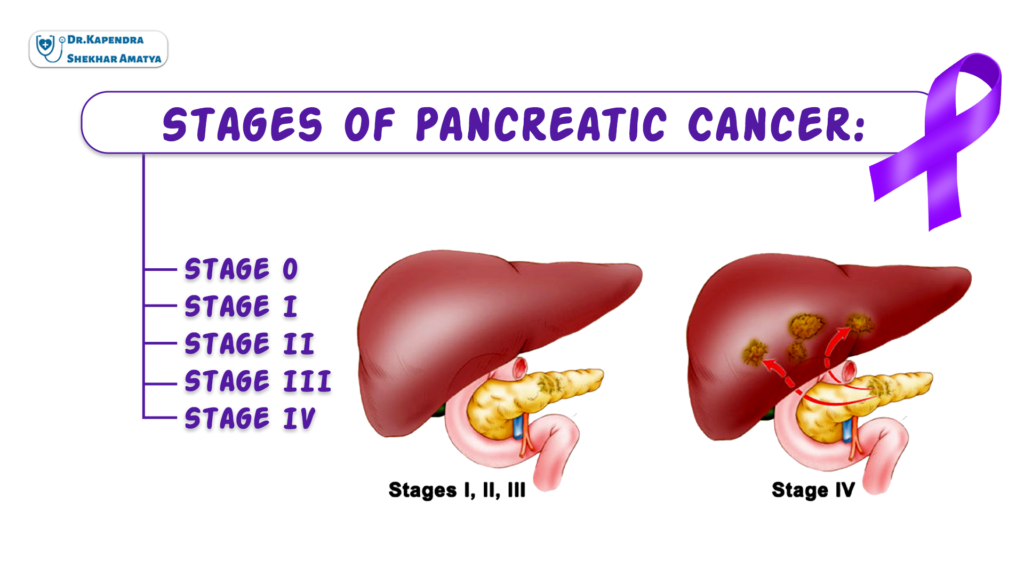 Pancreatic Cancer Dr Kapendra Shekhar Amatya