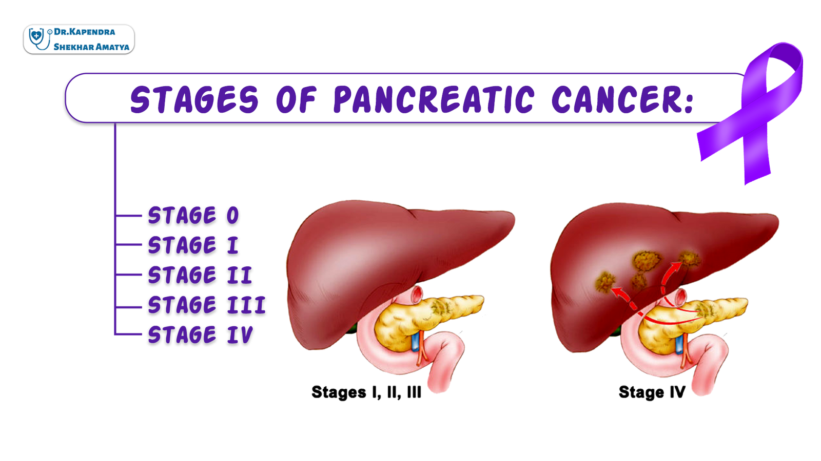 stages-of-pancreatic-cancer-dr-kapendra-shekhar-amatya