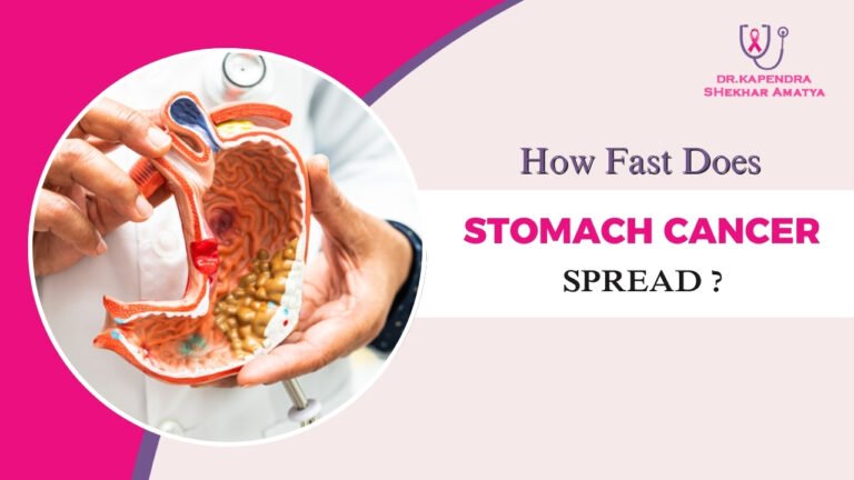 How Fast Does Stomach Cancer Spread