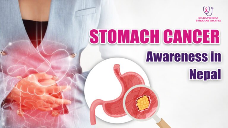 Stomach Cancer